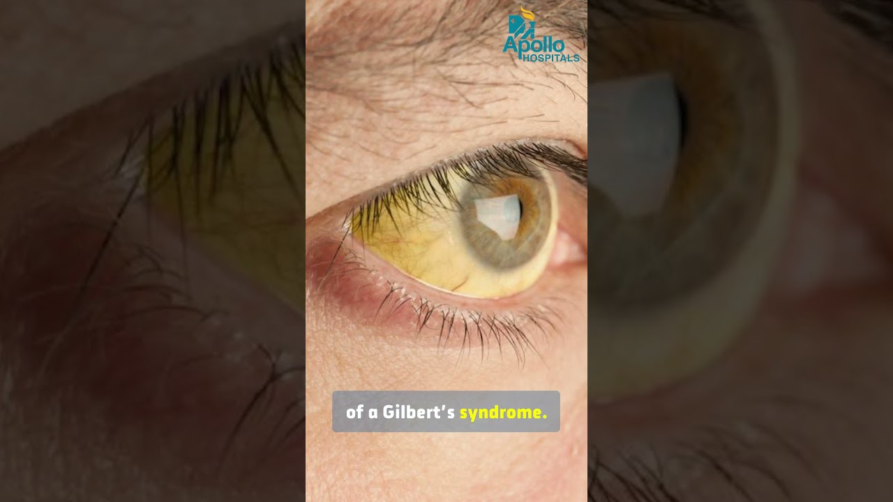 Gilbert syndrome overview | Dr Jatin | Apollo Hospitals