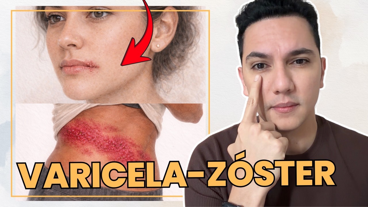 Varicela zoster: el virus que causa varicela y después culebrilla | Dr. William Guerrero 