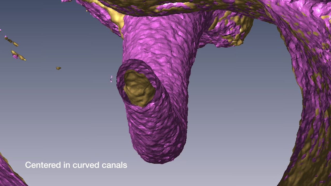 VDW Dental · Grande & Plotino: RECIPROC centering ability in curved canals (clinical video)