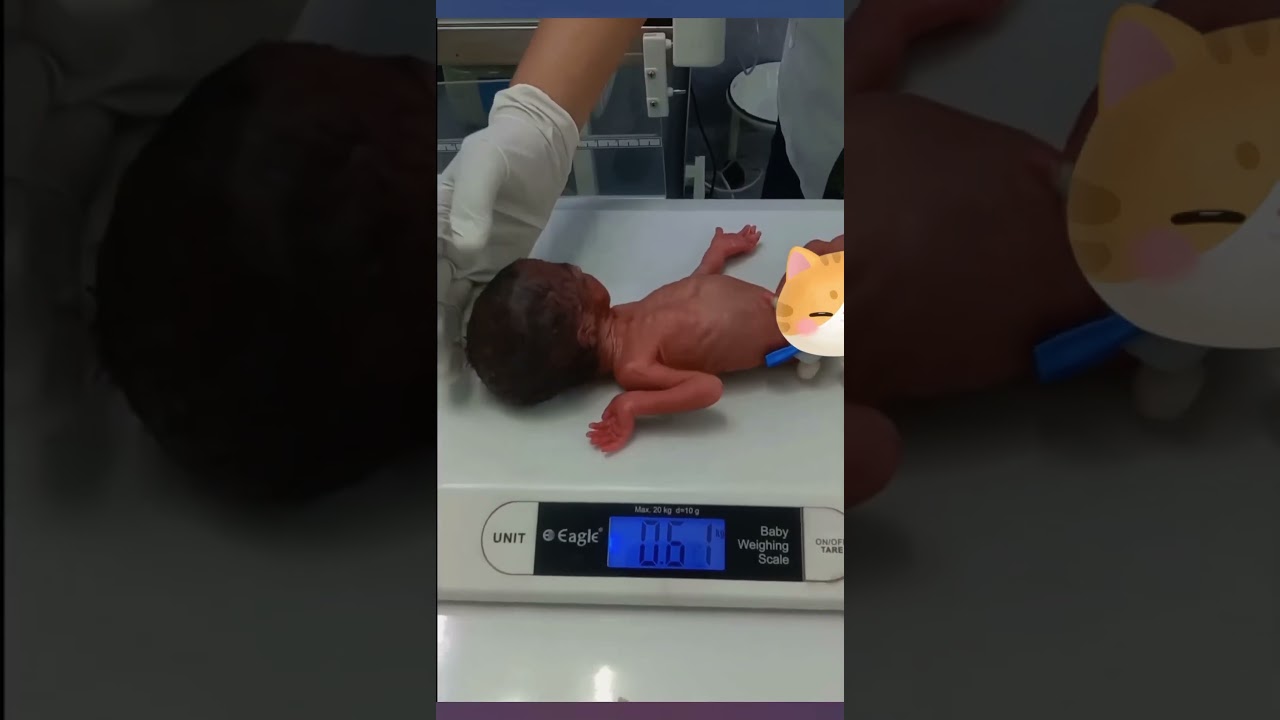 Amazingly tiny but stable preterm baby! ❤️