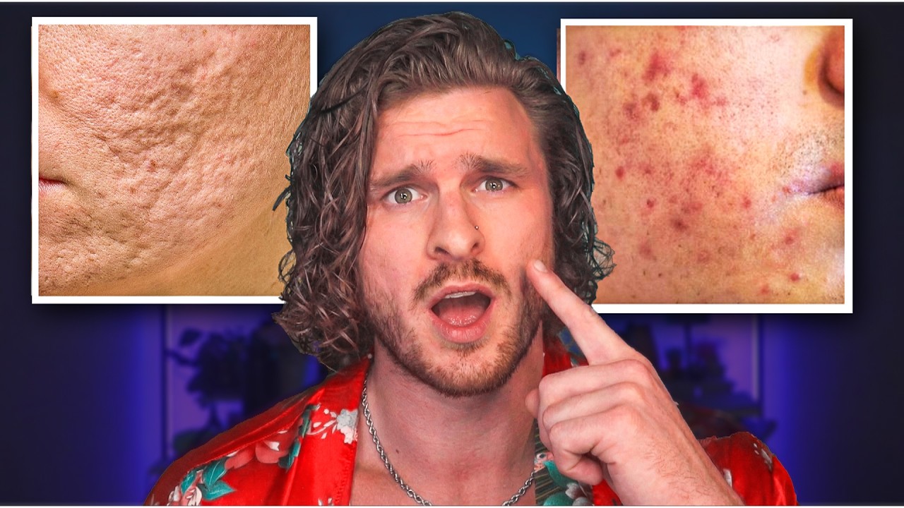 The BEST Way To Get Rid of Acne Scars (FROM EXPERIENCE)