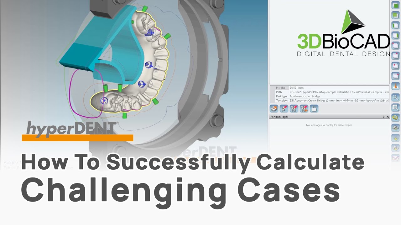 How To Successfully Calculate Challenging Cases l FOLLOW-ME! hyperDENT l 3DBioCAD