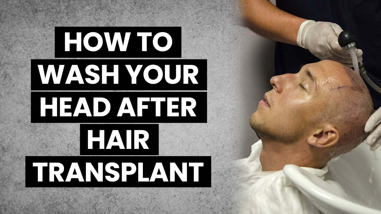 How to wash your head after FUE Hair Transplantation