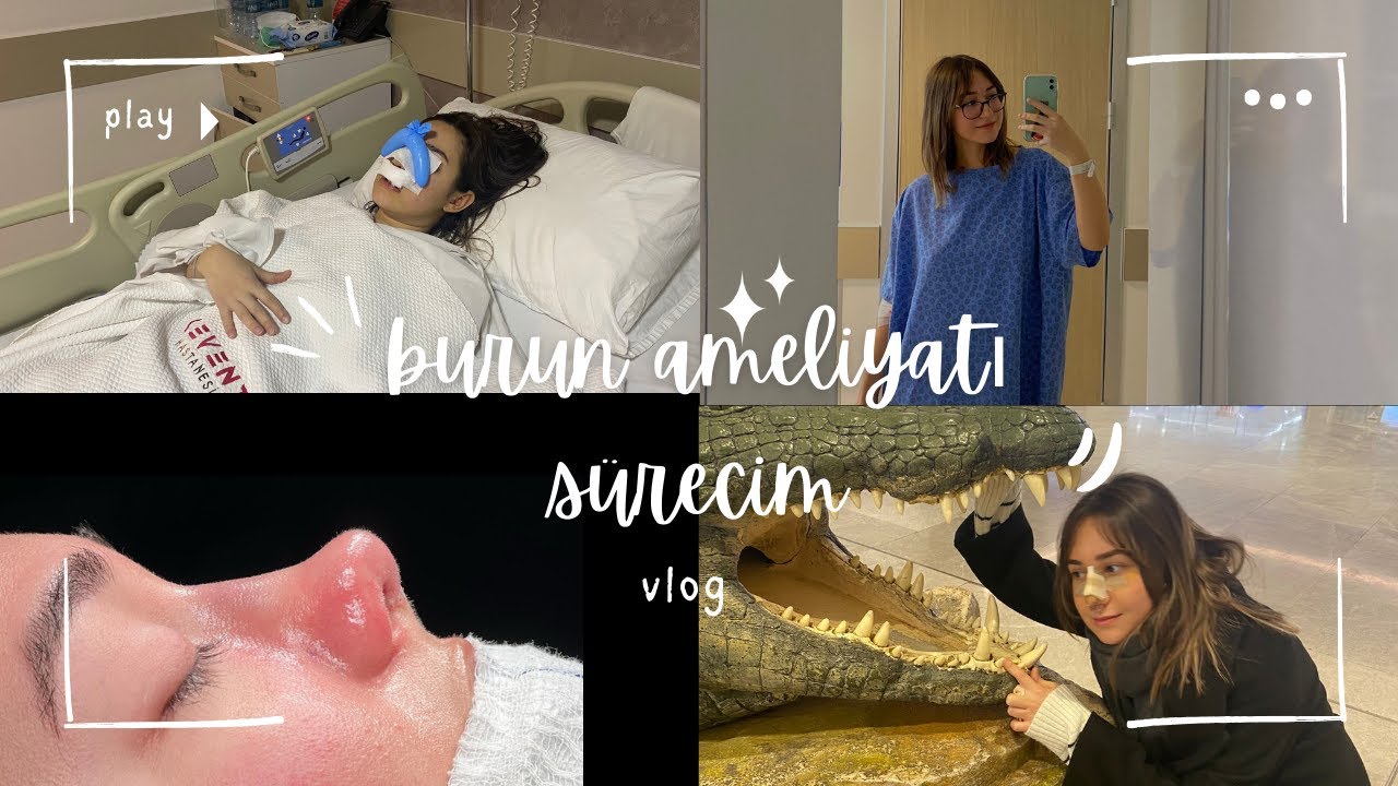 BURUN AMELİYATI OLDUM! | neler yaşadım? bütün süreç, vlog#5