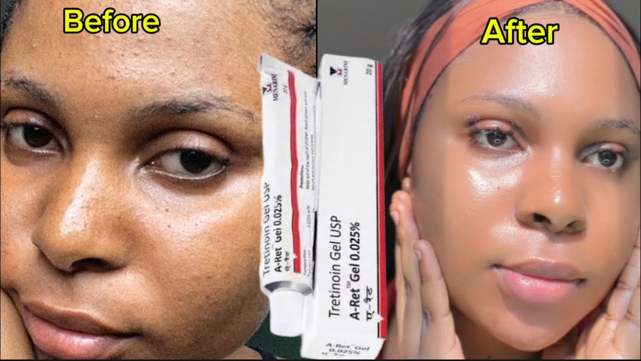 How to Get a Smooth and Glowing Skin With Tretinoin
