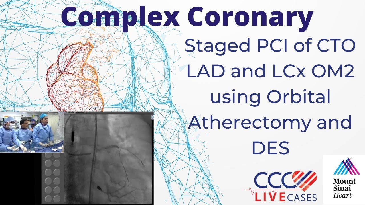 Staged PCI of CTO LAD and LCx OM2 using Orbital Atherectomy and DES - CCC Live June 2017