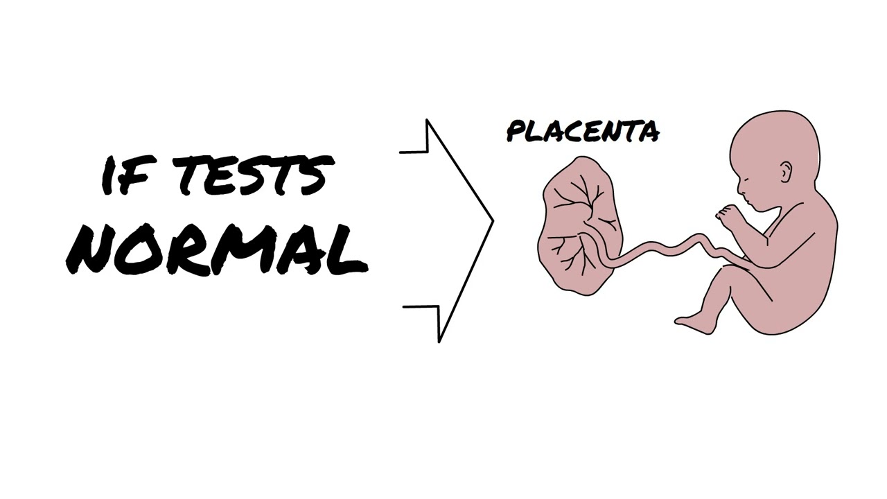 Neonate (newborn) Strokes | AboutKidsHealth at The Hospital for Sick Children