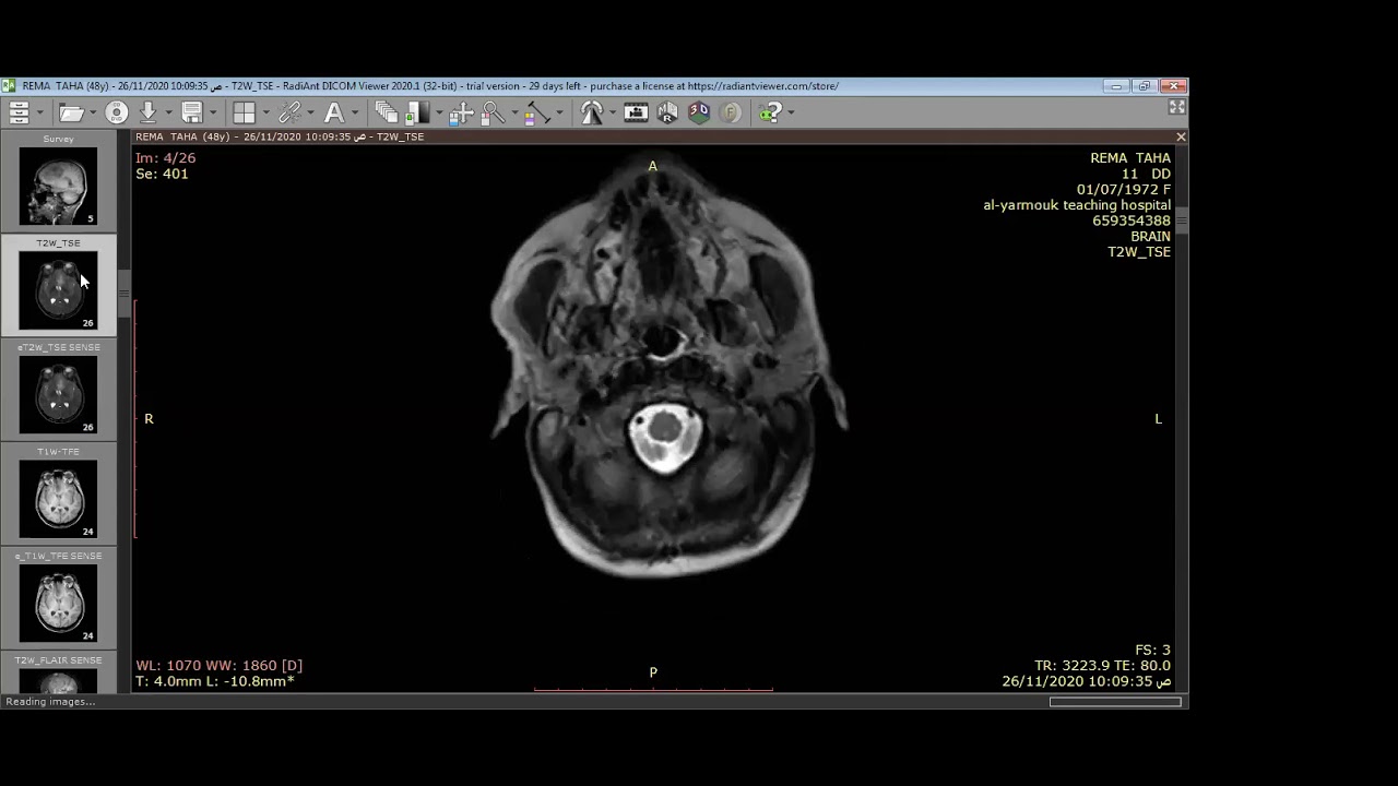 Oligodendroglioma