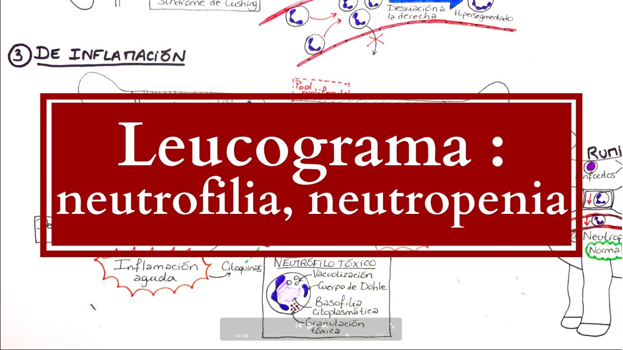 Leucograma : Alteraciones Neutrofílicas (neutrofilias, neutropenias)