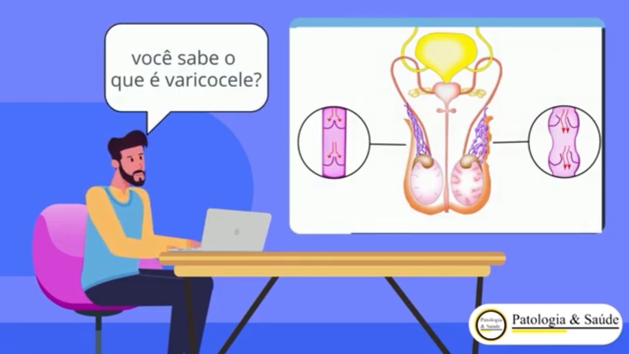 O que é varicocele e quais seus sintomas?