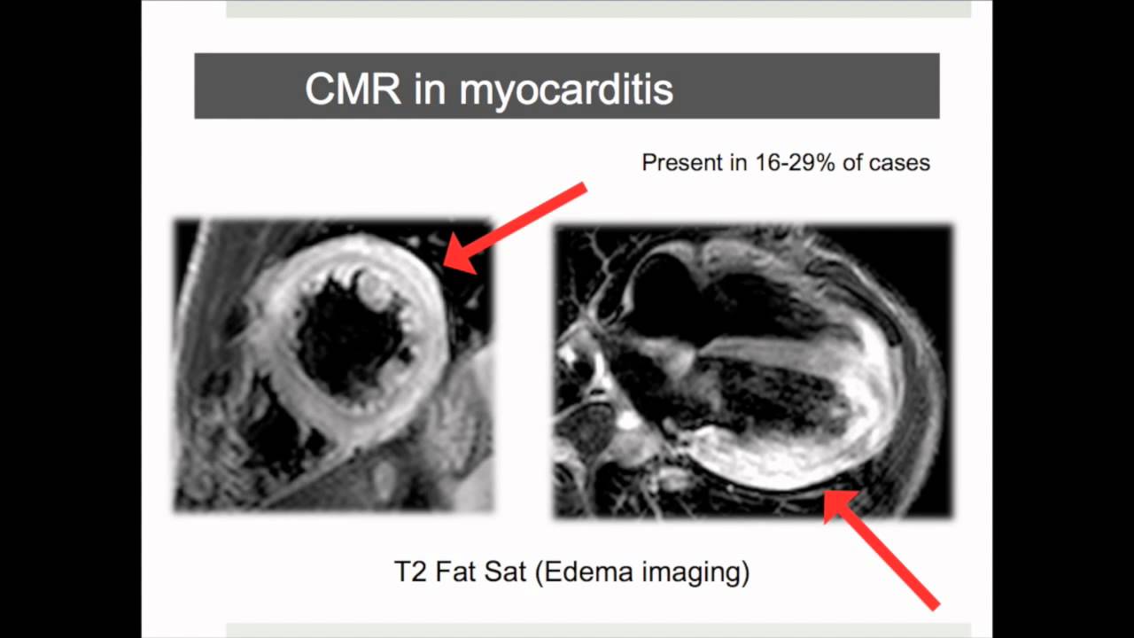 Why CMR Webinar: Introduction into Inflammatory Cardiomyopathy - Part I (viral myocarditis)