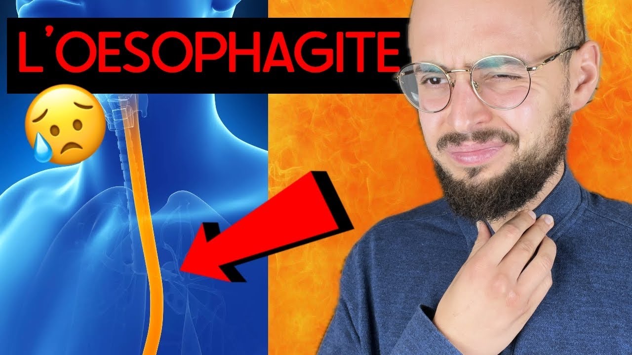 ŒSOPHAGITE : causes, symptômes et traitements