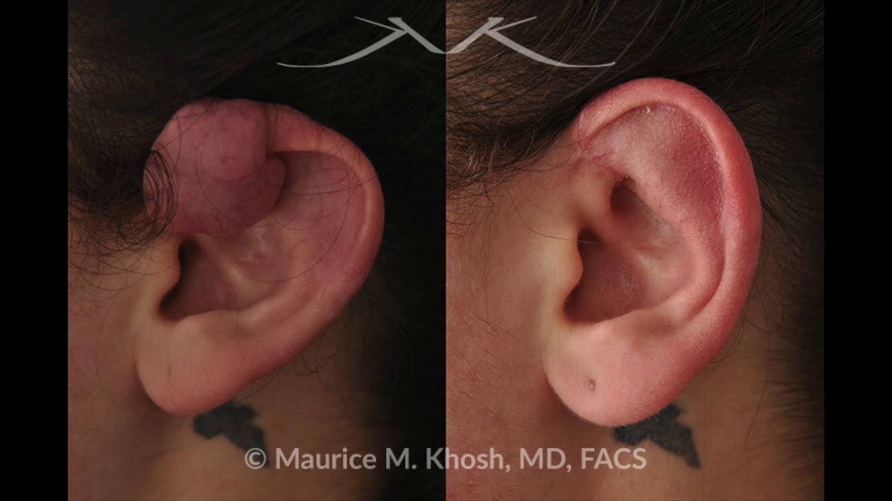 NYC Keloid Scar Removal | UES Keloid Scars Treatment | Dr. Maurice Khosh Facial Plastic Surgeon