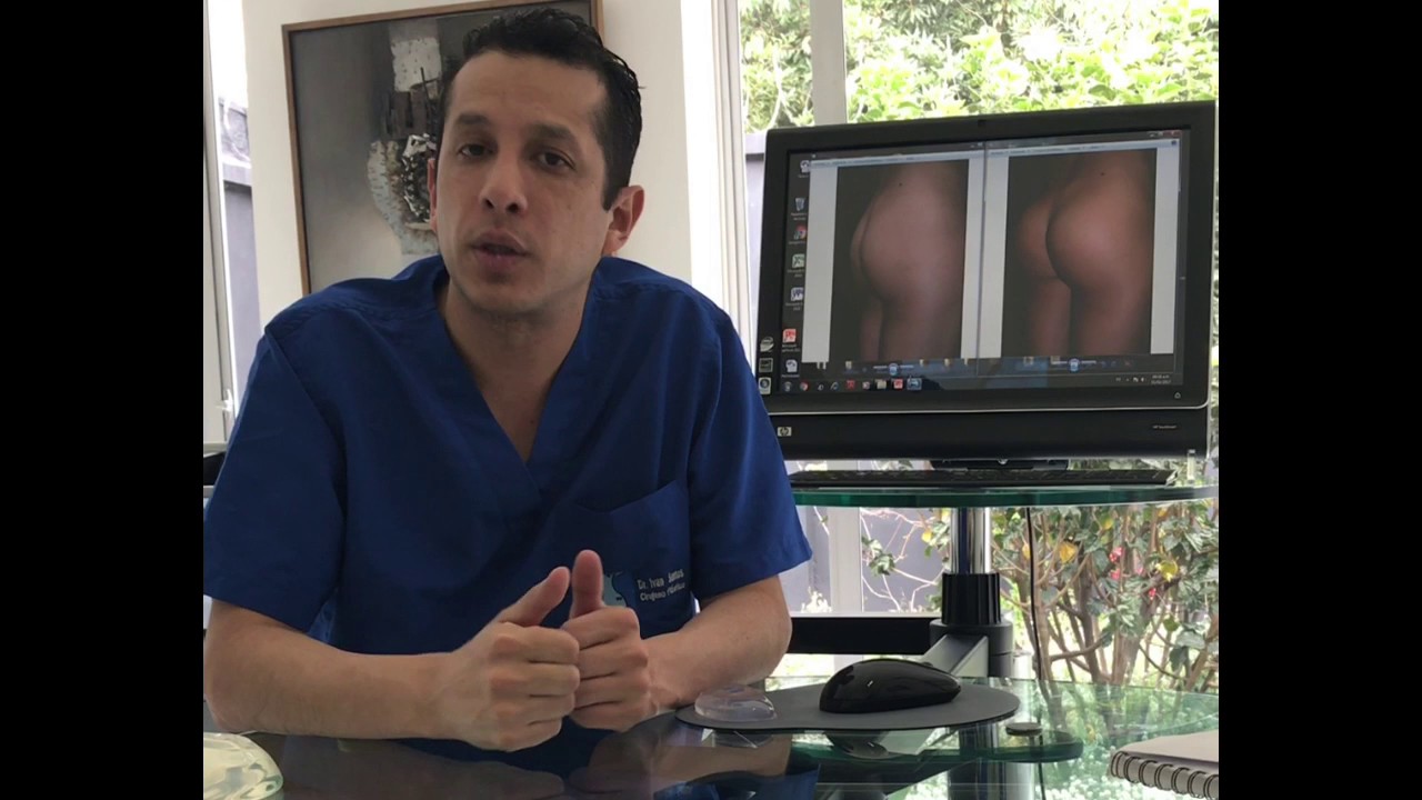 Gluteoplastia con implante | Dr. Ivan Santos - Cirugía plástica en Colombia |