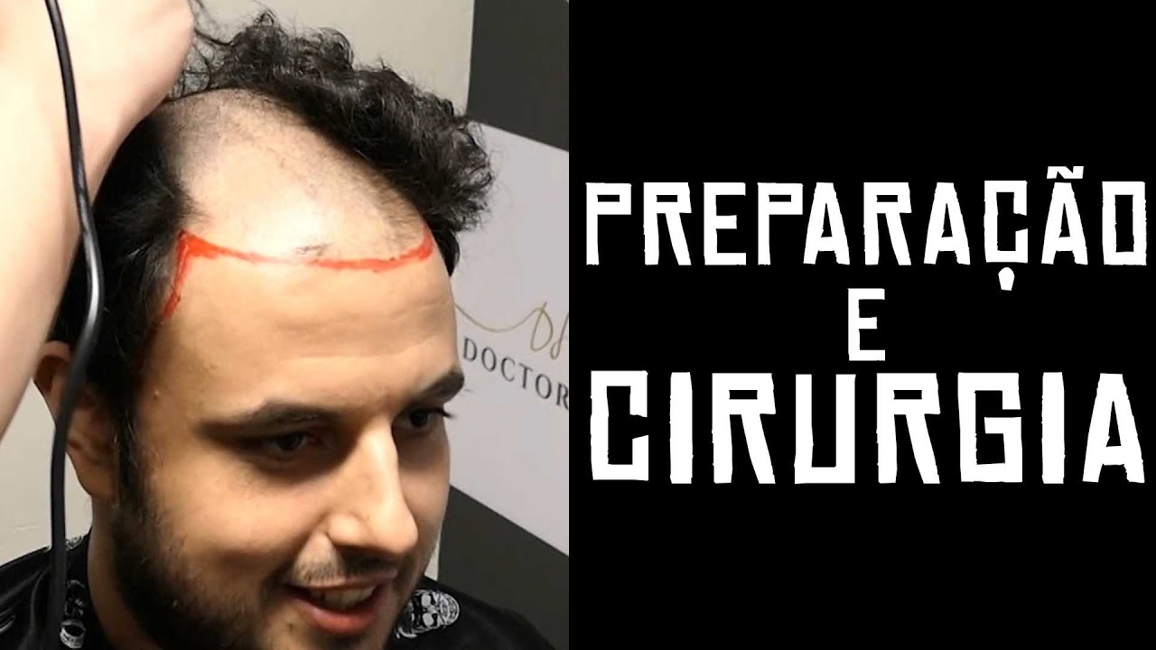 Dr Stanley Bittar - Prepara&ccedil;&atilde;o e cirurgia de transplante capilar
