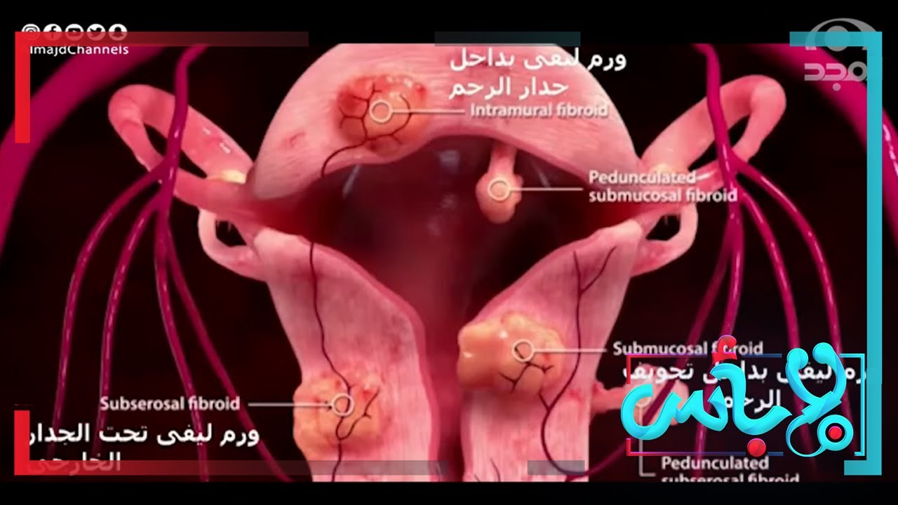 أورام الرحم الليفية.. كيف تتكون وما الأعراض؟ وما دور الأشعة التداخلية في العلاج؟  | برنامج لابأس