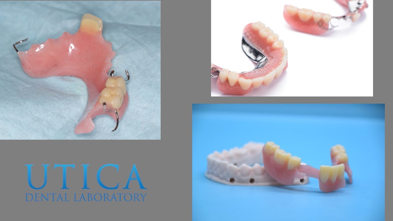 Denture FAQs - Types of Dentures and False Teeth