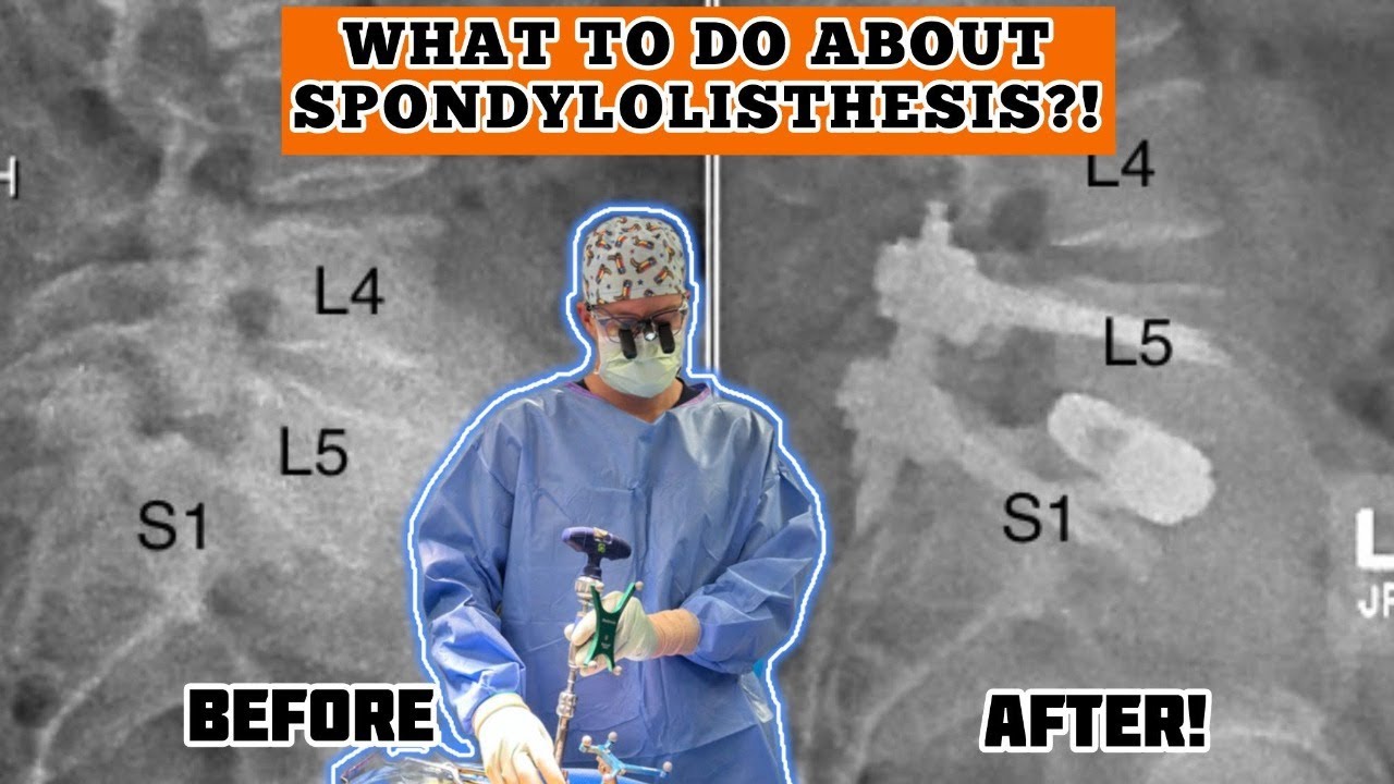 What is spondylolisthesis?