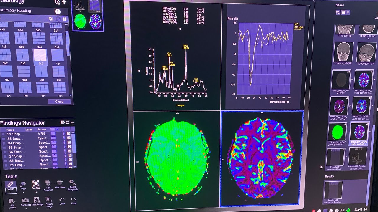 MRI BRAIN PERFUSION & SPECTROSCOPY