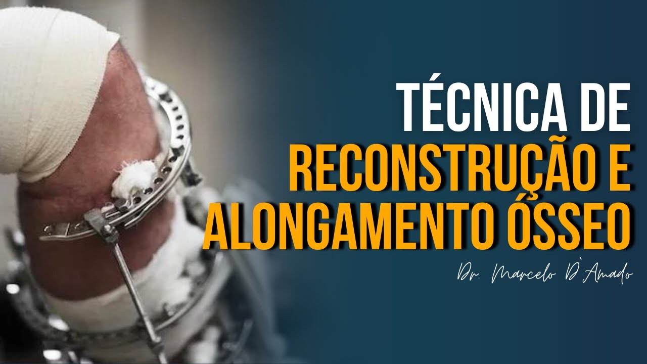 O PODER DA REGENERAÇÃO: TÉCNICAS DE ALONGAMENTO ÓSSEO E OSTEOGÊNESE POR DISTRAÇÃO!