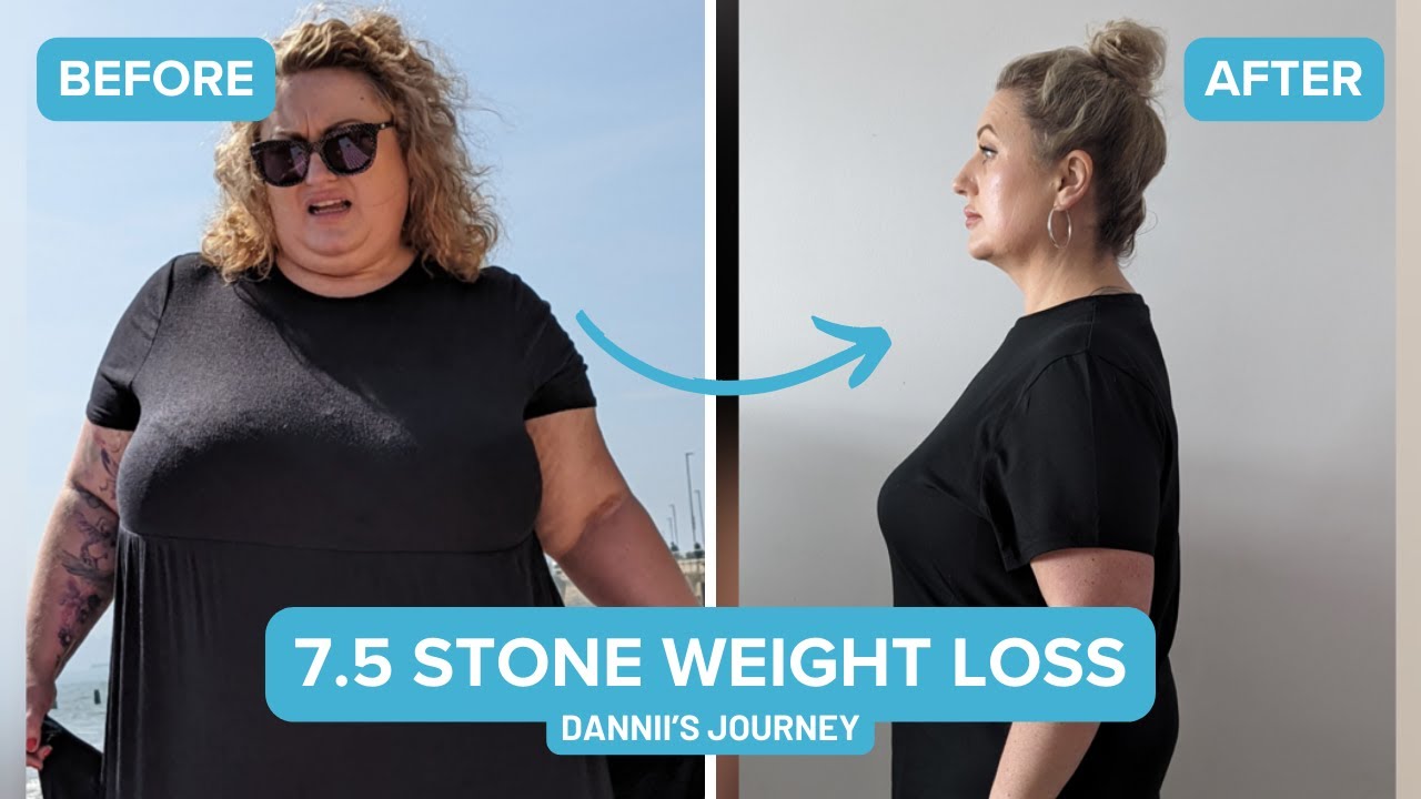 Dannii's Gastric Sleeve - 7.5 Stone Weight Loss