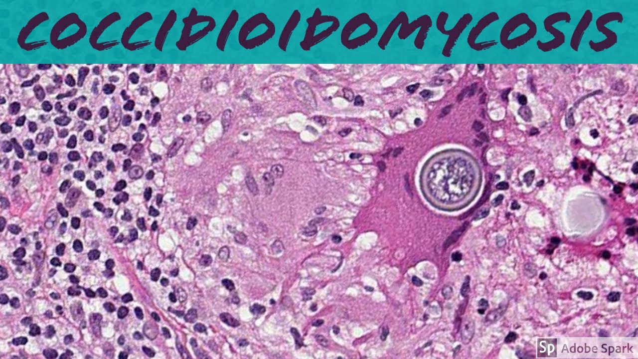 Coccidioidomycosis (Coccidioides): 5-Minute Pathology Pearls