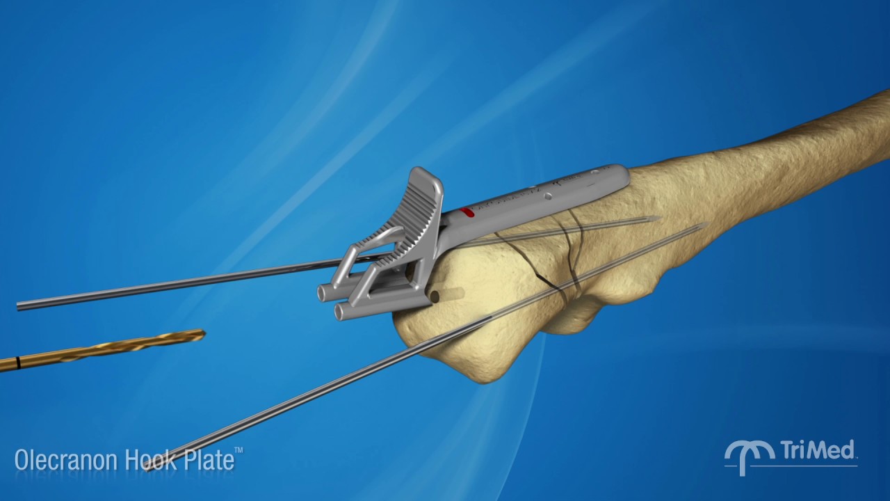 Olecranon Hook Plate Surgical Animation