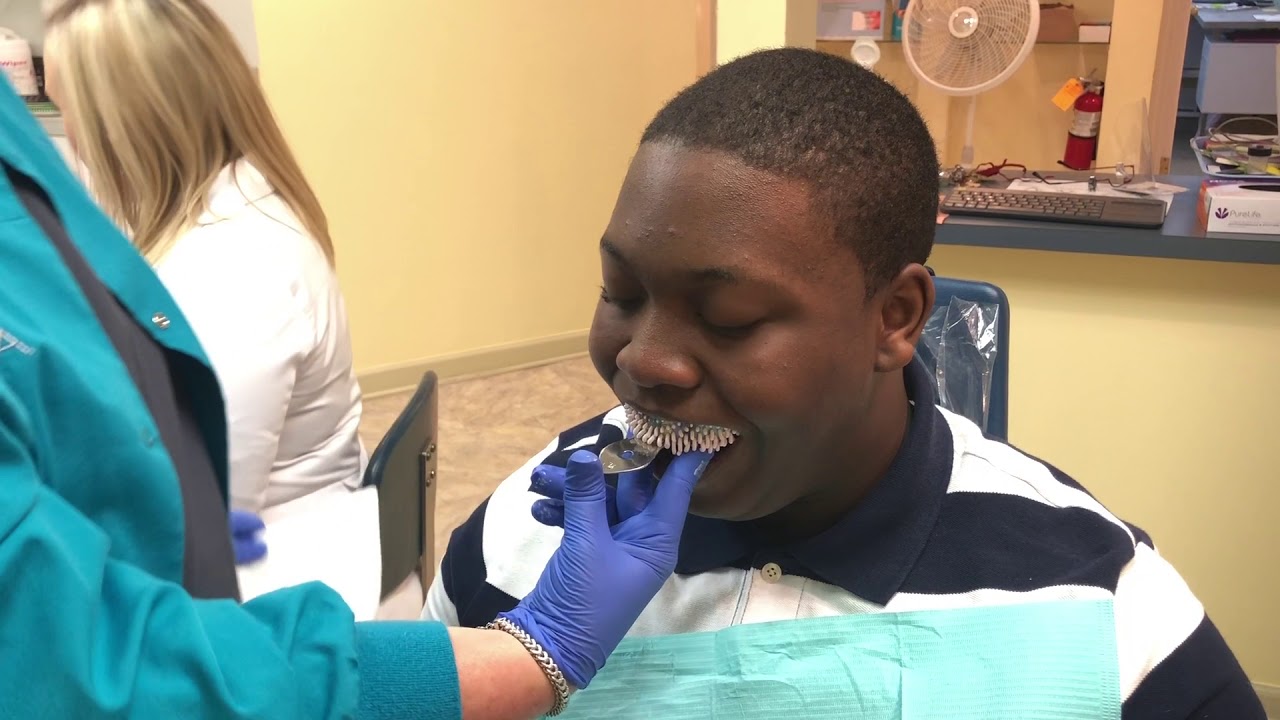 Orthodontic Impressions @ Grosso Orthodontics