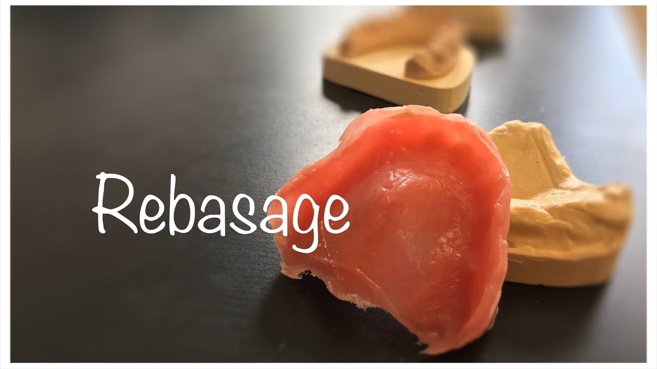 Rebasage d'une prothèse