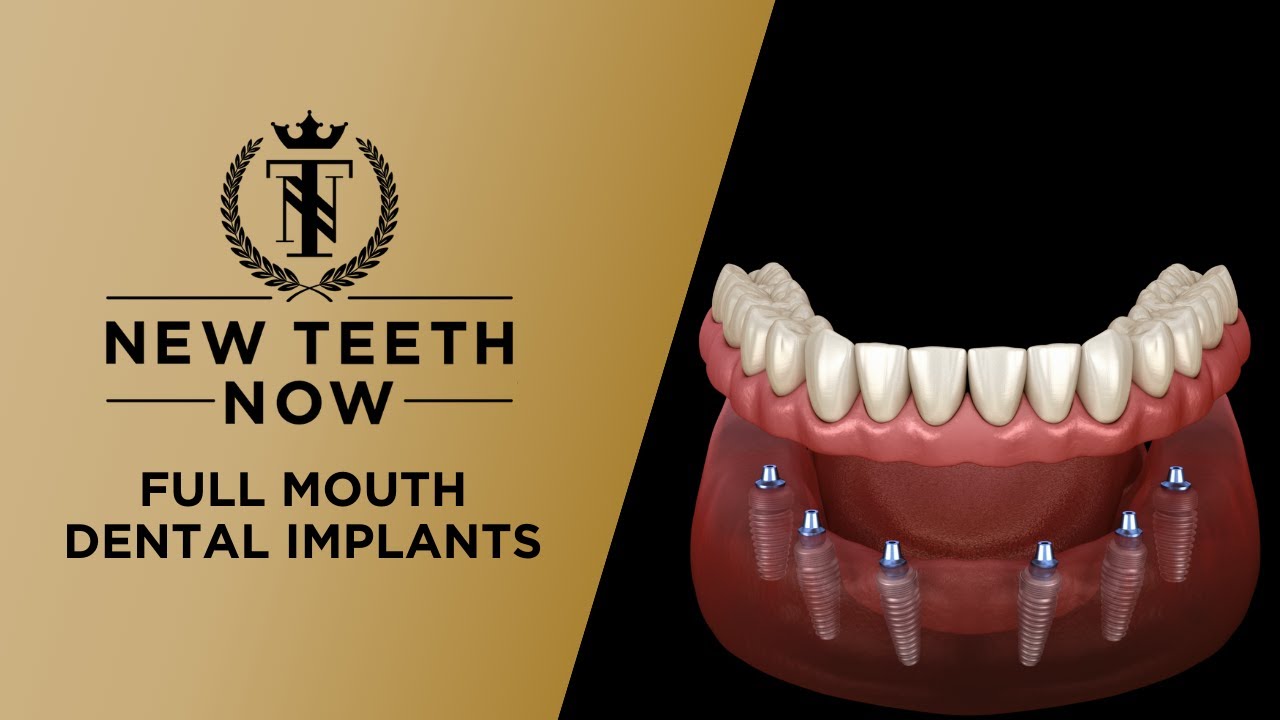 Full Mouth Dental Implant Procedure