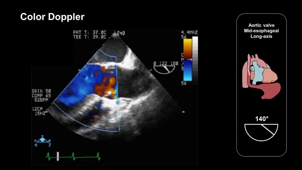 Assessing the aortic valve using TEE (mid-esophageal long-axis view)