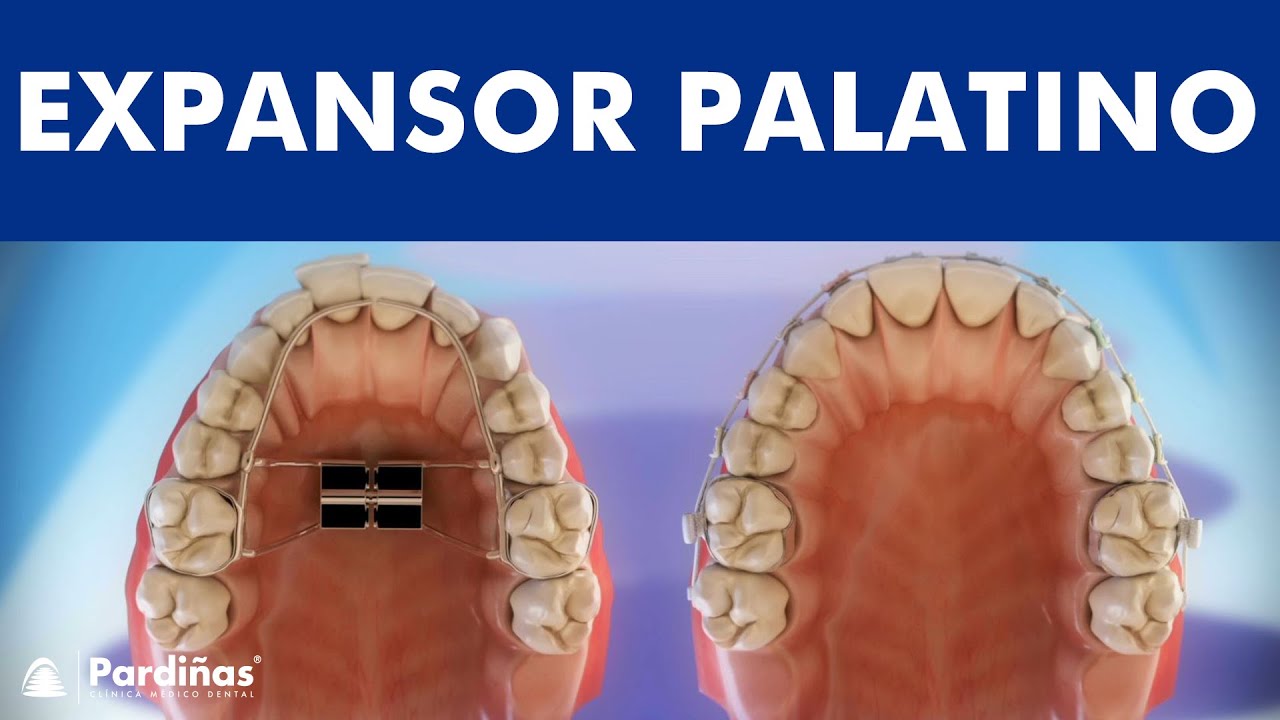 Ortodontia - Expansor Palatino e Aparelho Extra Bucal ©