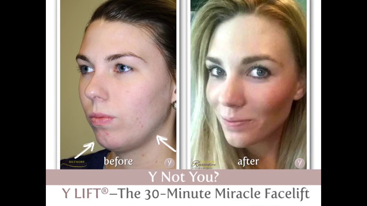 Lauren talks about how the Y-Lift Procedure Changed her Life