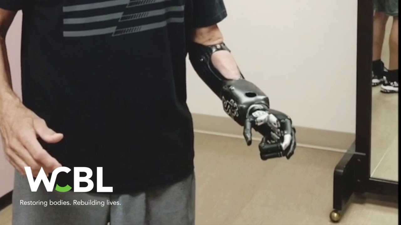 Myoelectric Upper Extremity Prosthetic Device
