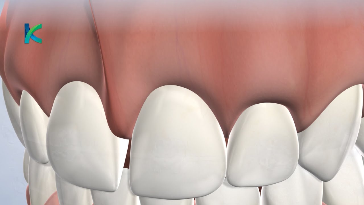 Frenectomy in Louisville, KY