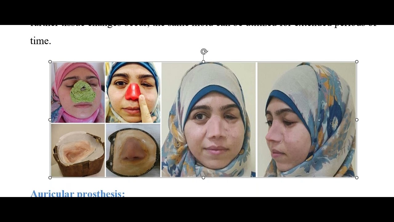 Maxillofacial prosthesis