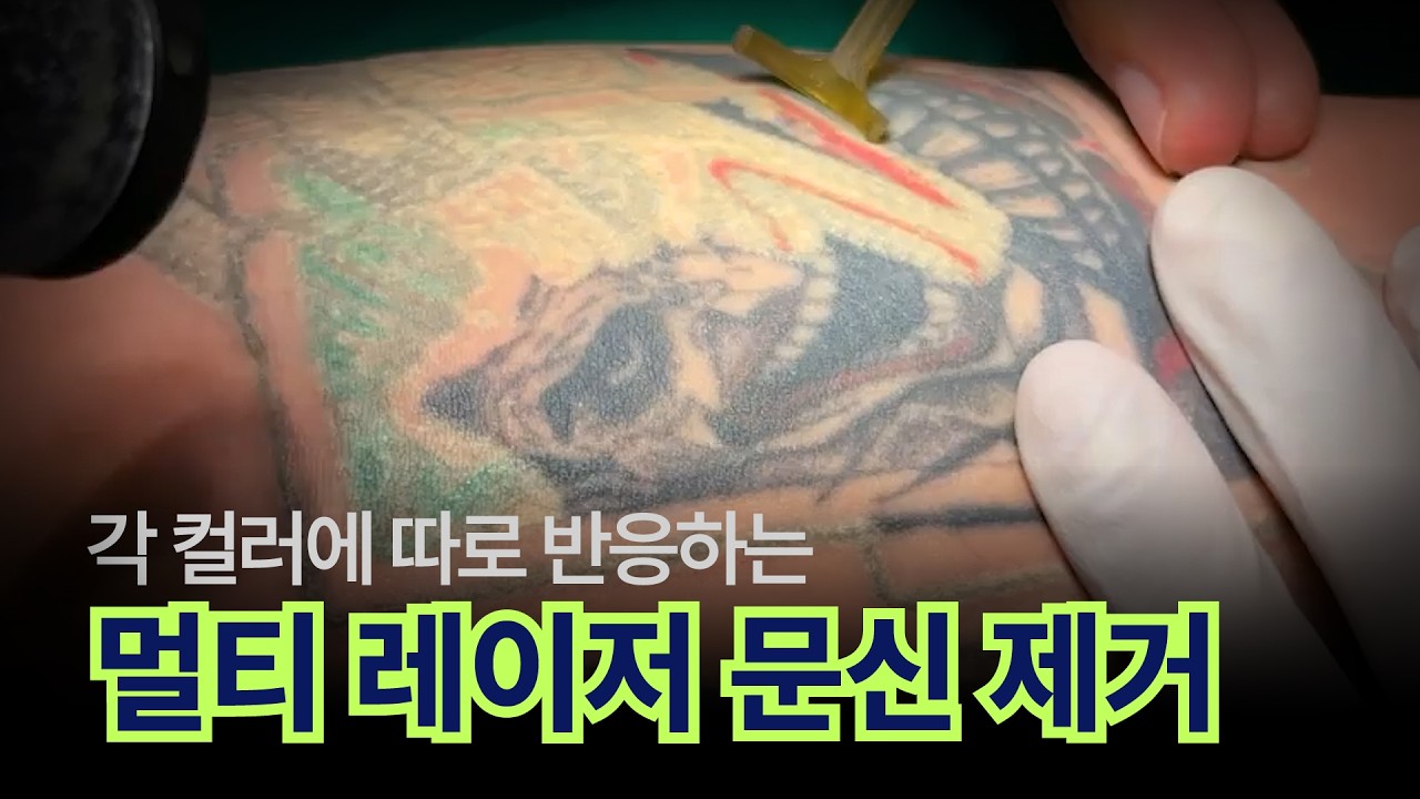 멀티 레이저로 지우는 컬러 문신 [#문신제거] ㅣ Tattoo Removal