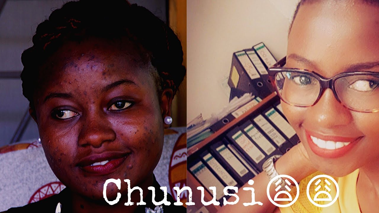 Jinsi Nilivyotibu Chunusi na Makovu Usoni  | My story