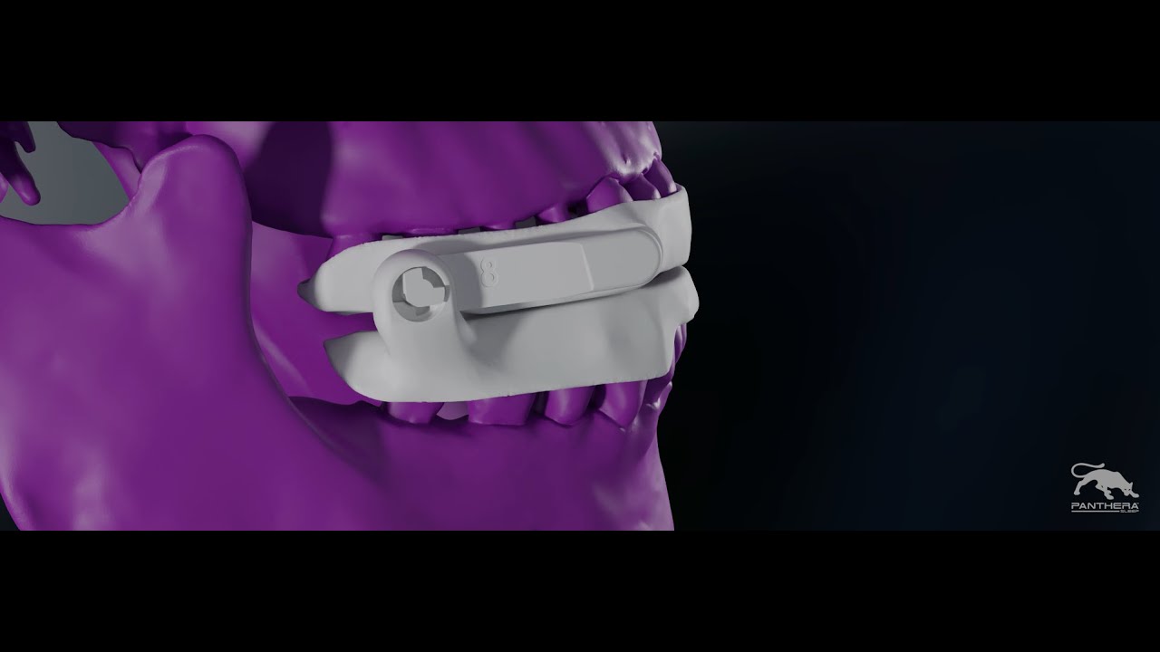 Changing rods - How to adjust titration of a D-SAD Classic (increase/decrease the jaw advancement)