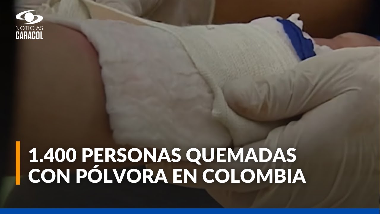 Autoridades revelan el número de personas que resultaron quemadas con pólvora durante diciembre