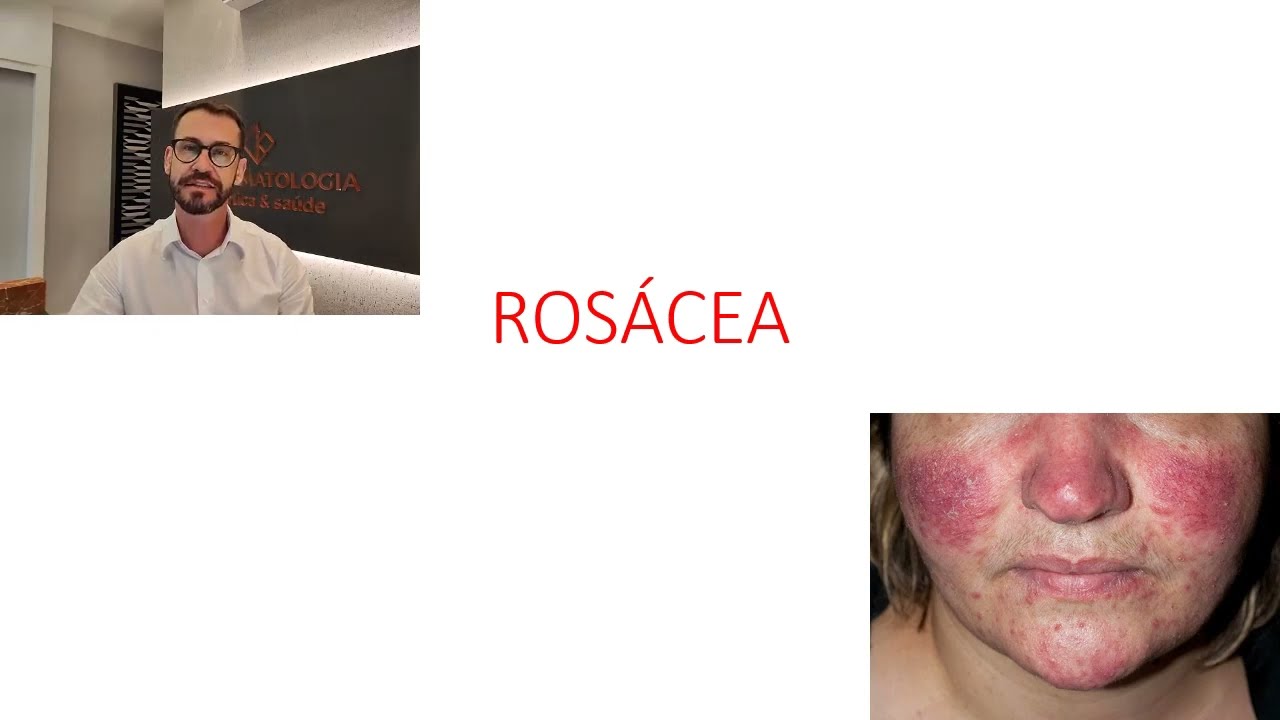 Aula 01 - ROSÁCEA
