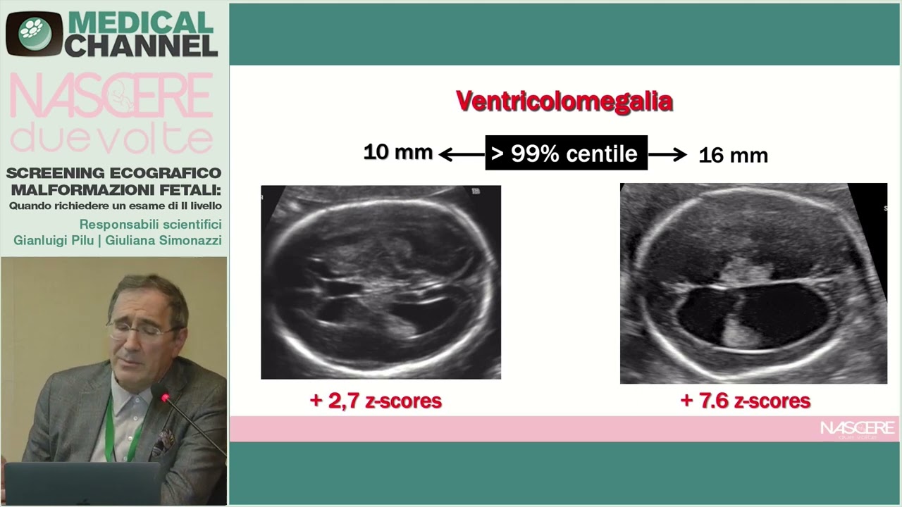 Biometria fetale e i marcatori ecografici - Gianluigi Pilu