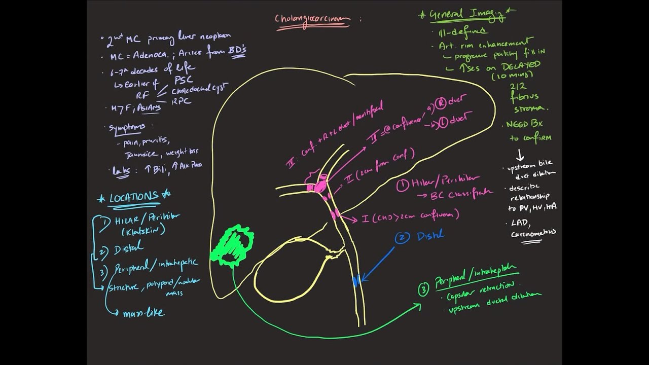 Cholangiocarcinoma