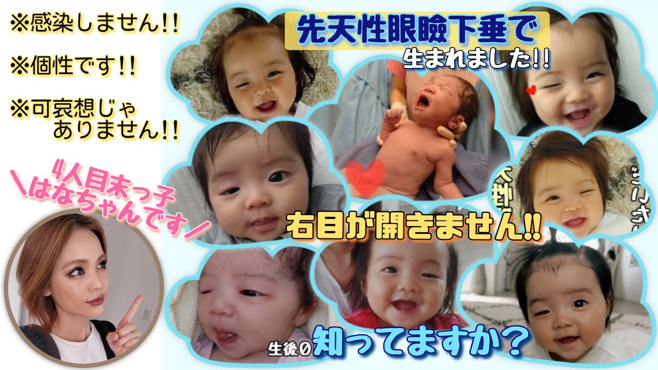 生まれつき右目が開きません👀【先天性眼瞼下垂】末っ子はなちゃんについてお話します。
