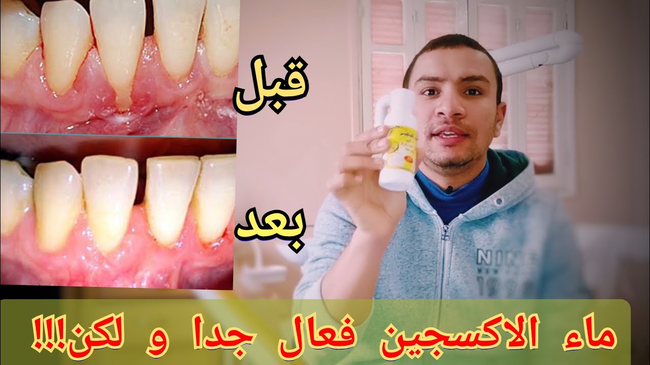 بدولار واحد فقط عالج ( التهاب اللثه - تراجع اللثه - التهاب ضرس العقل) كيف يستخدم ماء الاكسجين