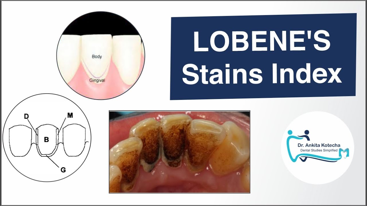 DENTAL STAINS INDEX/LOBENE'S INDEX/MACPHERSON 'S MODIFIED INDEX/ DR. ANKITA KOTECHA
