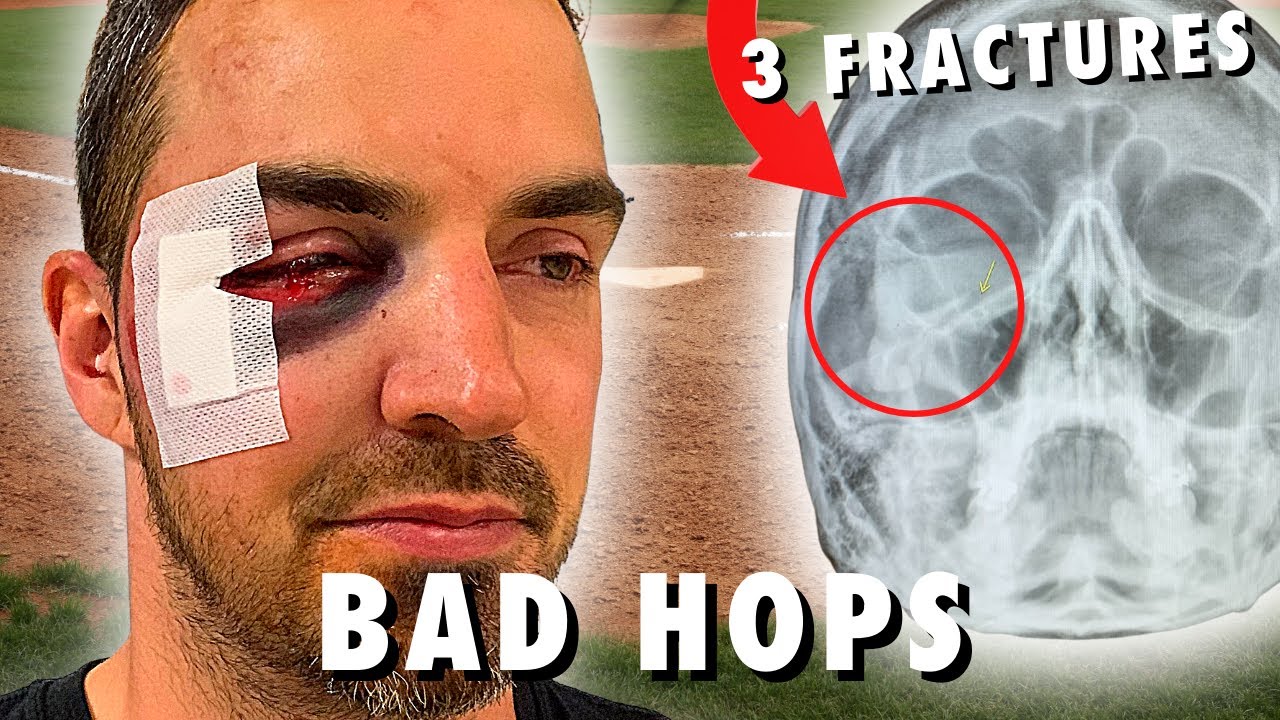 3 Quick Tips To Prevent Bad Hops In Baseball