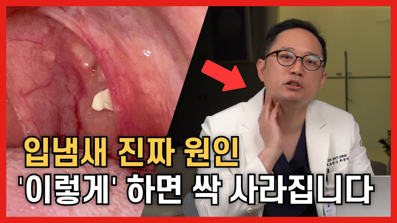 입에서 나는 똥냄새의 비밀! 편도결석 없애는 방법과 편도제거수술 오해와 진실