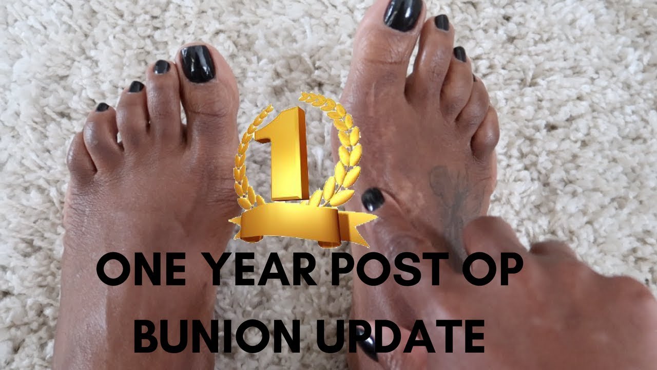 1 YEAR POST OP BUNION SURGERY UPDATE 2018