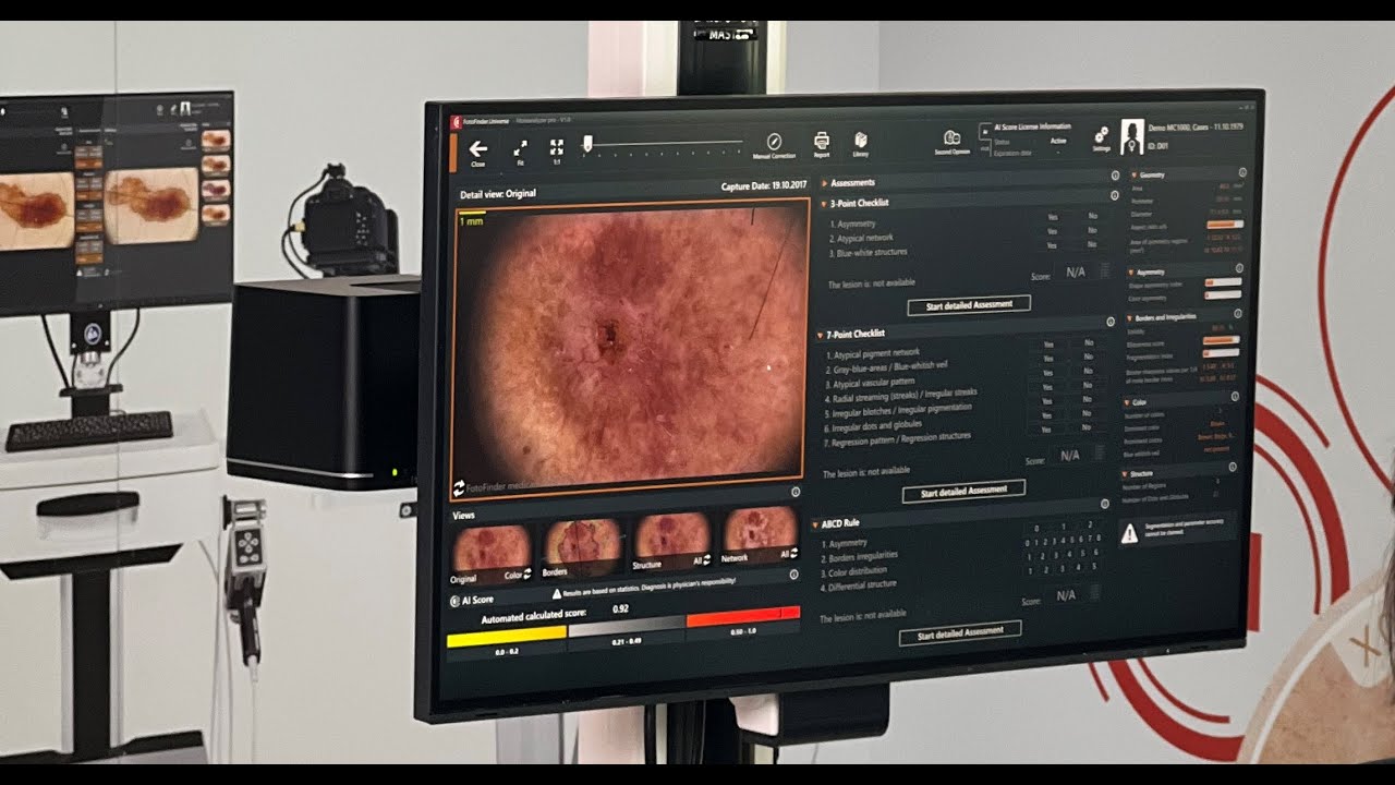 FotoFinder-  urządzenie do wideodermatoskopii, które pozwala na wczesne wykrycie czerniaka